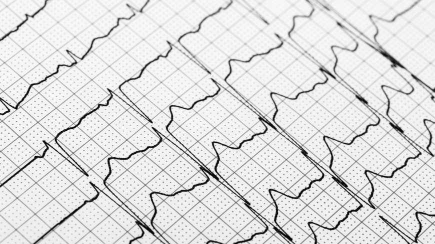 Webb-TV: Förmaksflimmer